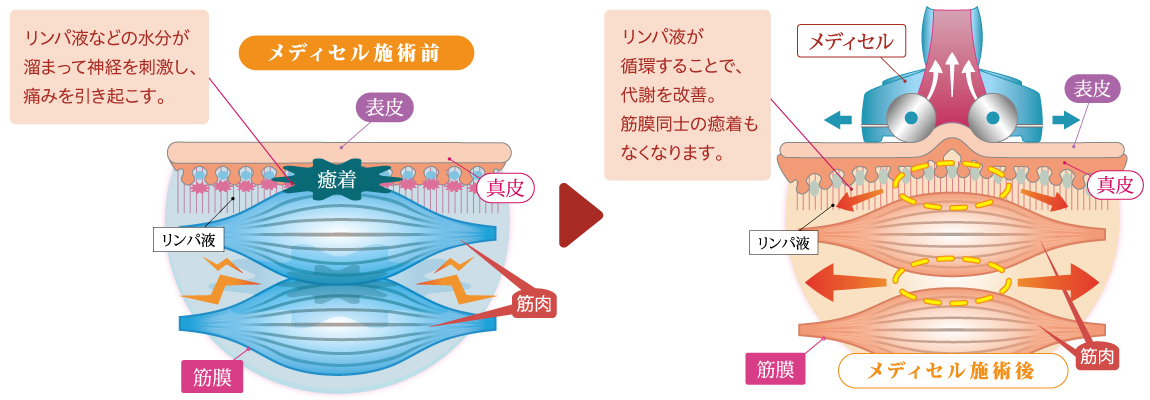 筋膜リリース｜下高井戸ヒーリングプラザ